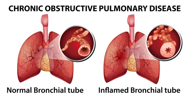 RESPIRATORY DISEASE IN CHILDREN